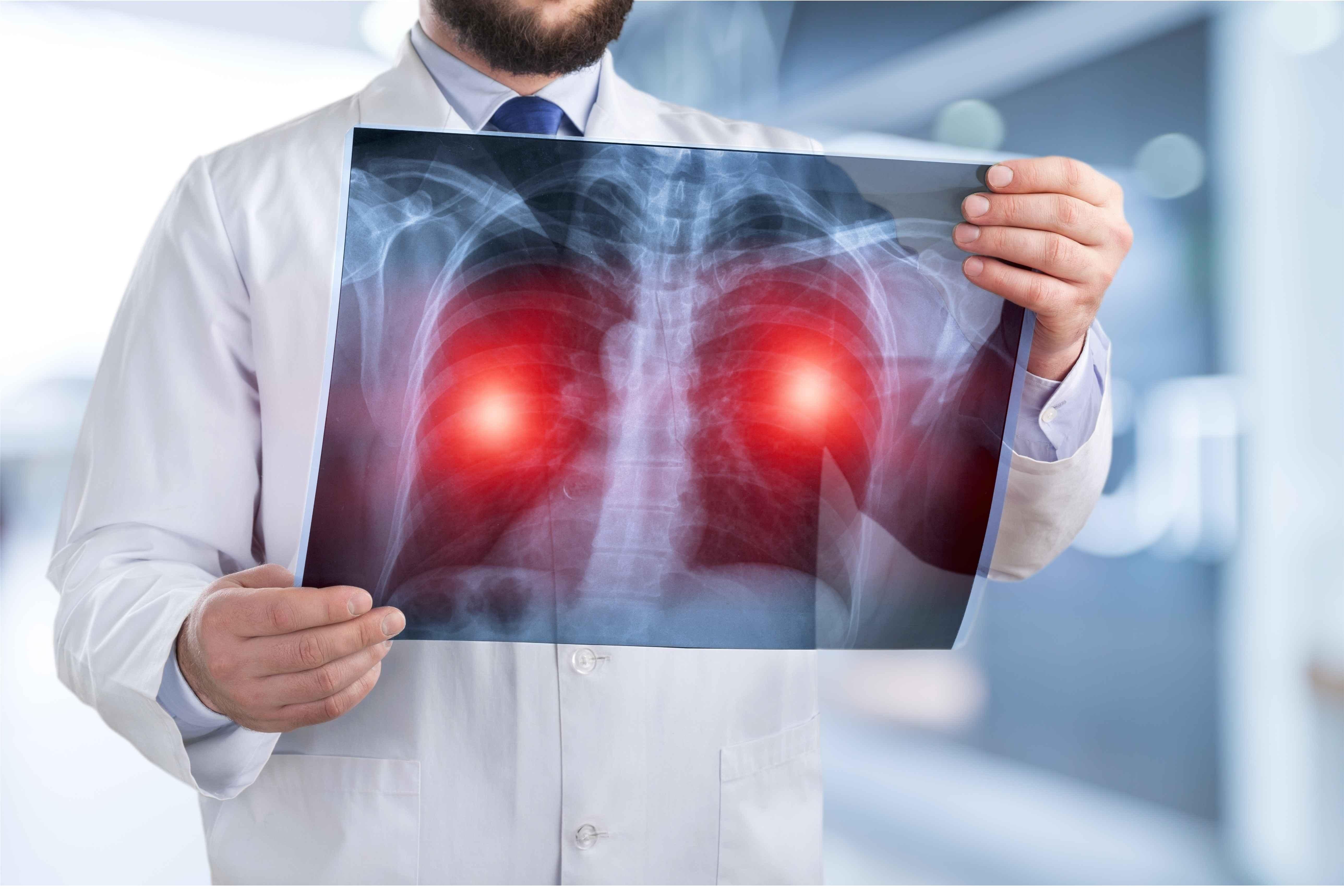 肺癌病友交流群，肺癌的体征与症状有哪些？什么是副肿瘤综合症？