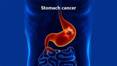 什么是胃癌？