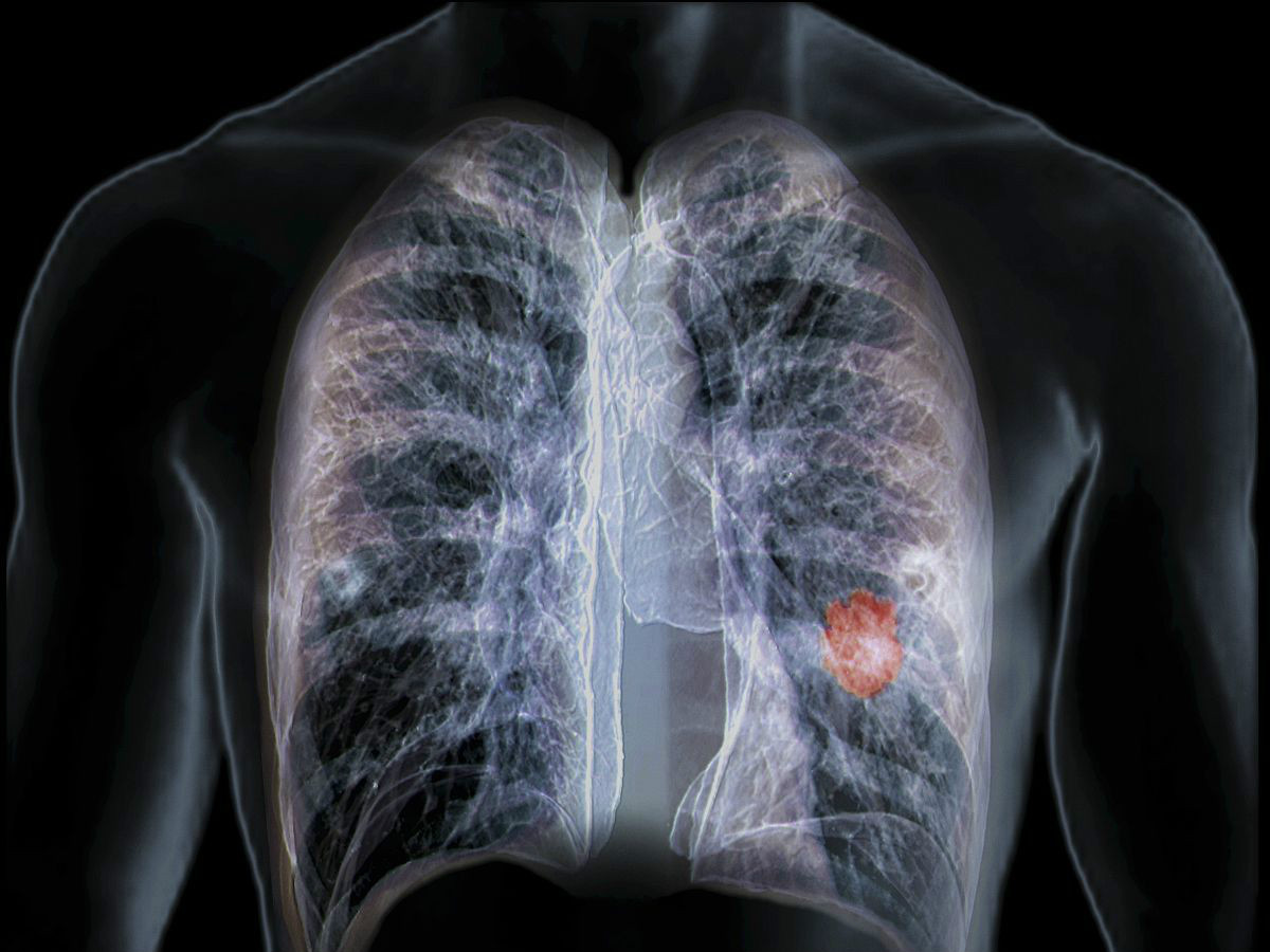 免疫疗法可以帮助患有小细胞肺癌患者吗？
