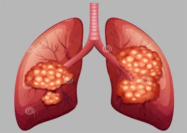 肺癌从早期到晚期一般需要多长时间？