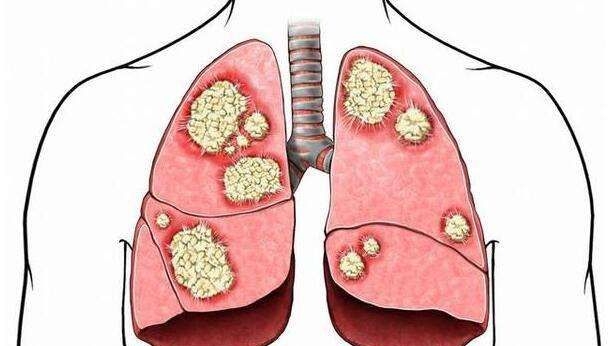 肺癌早期症状表现 警惕这五大症状