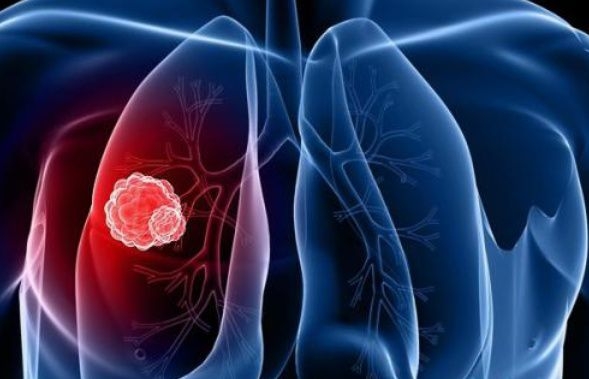 肺癌中期症状及表现 肺癌中期能治好吗？能活多久