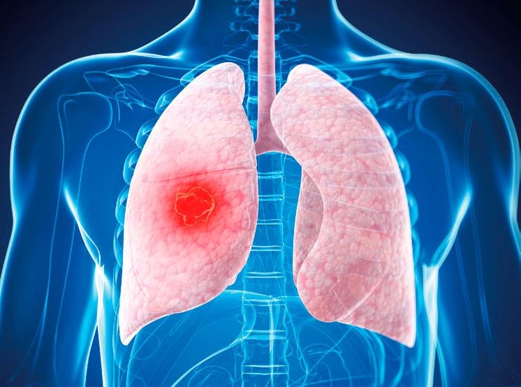 肺癌传染吗，通过什么方式传染 看到这个内容终于明白了！