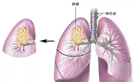 肺癌后期吐血怎么办，肺癌病友交刘群，肺癌病友咨询互助群