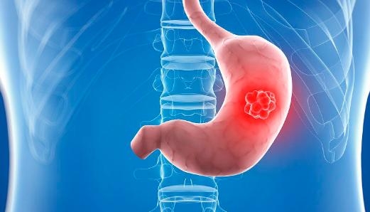 胃癌晚期症状能治愈吗 胃癌晚期不治疗的话一般能活多久？