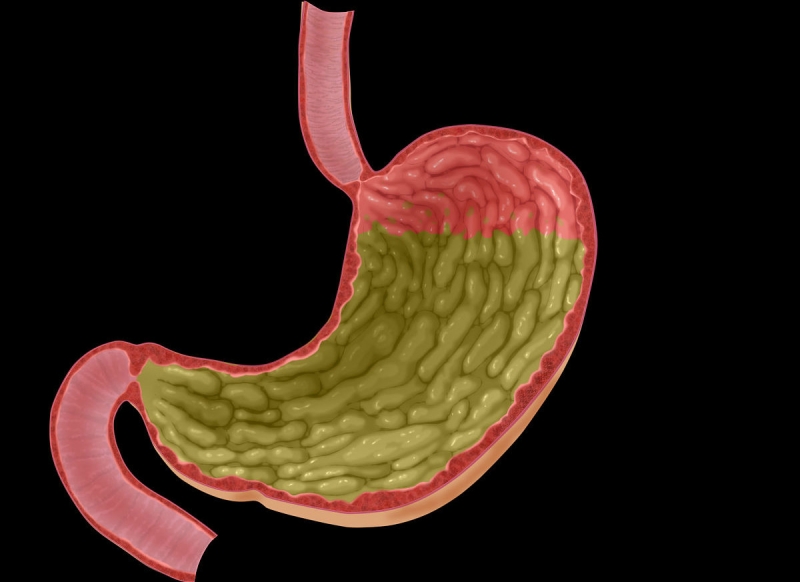 胃癌三大信号 胃癌早期身体会有3处痛，这5类人是高危人群