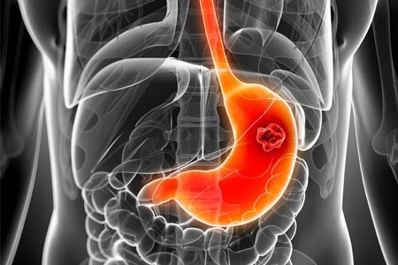 胃癌中期治疗方案有哪些 胃癌中期术后存活多久？
