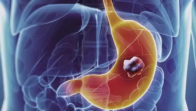 胃癌初期的症状是什么样的？胃癌早期症状和前兆期症状及表现