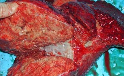 肝癌中期做介入治疗还能控制多久 肝癌中期介入手术意义到底大不大？